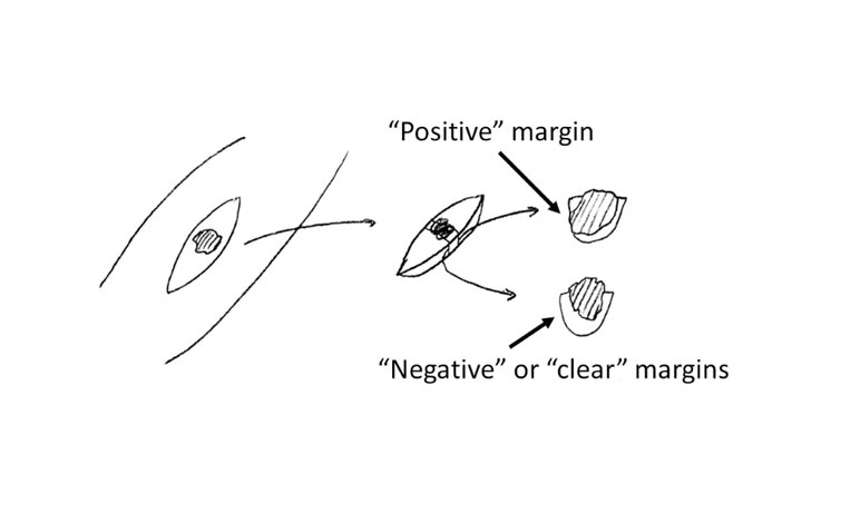 tissue margins