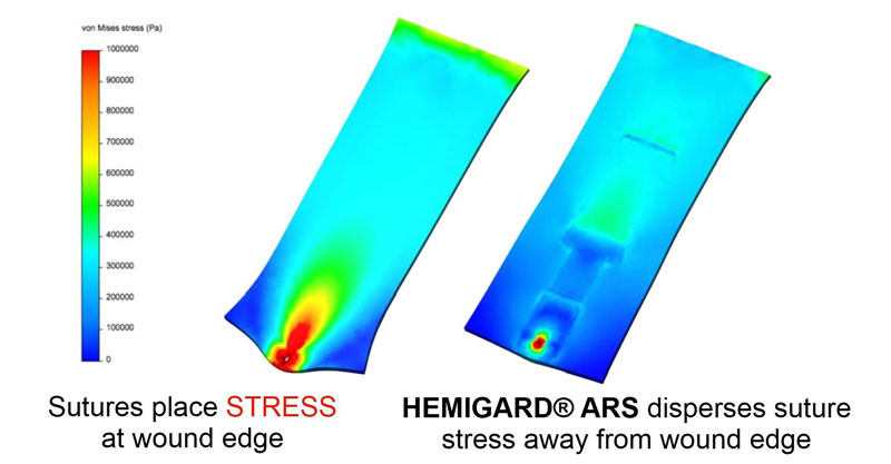 How HEMIGARD®® ARS Makes Standard Sutures Better